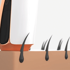 Showing how IPL Laser works -Lumilia Skin Co